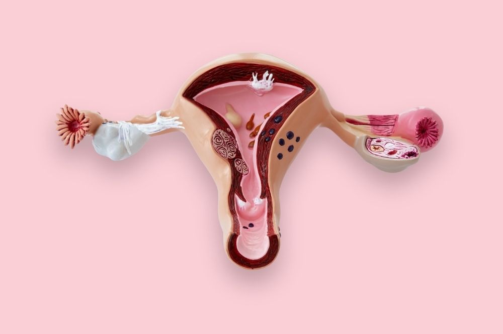 Endometriozis Endometriozis